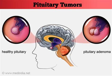 Pituitary Tumors - Causes, Symptoms, Diagnosis, Treatment