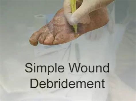 What Is Debridement Of Wound: A Comprehensive Guide