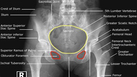 Hip X-ray Interpretation - OSCE Guide | Geeky Medics