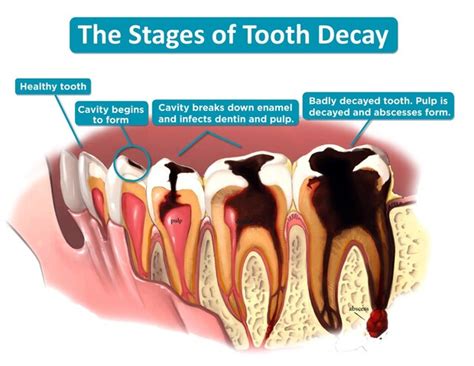 Tooth Decay - DENTAL EXCELLENCE