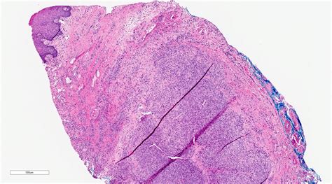 Mucocele Histology