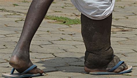 Elephantiasis – Facts, Symptoms, Causes, Treatment