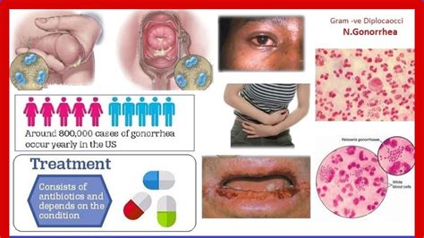 GONORRHEA, CAUSES, SIGNS AND SYMPTOMS, DIAGNOSIS AND TREATMENT - YouTube