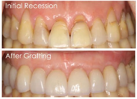 Tissue Grafting with a Multi-Disciplinary Approach | Anderson ...