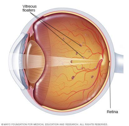 Vitreous Floaters Removal - South Carolina - Dr. Lowrey King