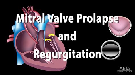 Mitral Valve Prolapse With Regurgitation