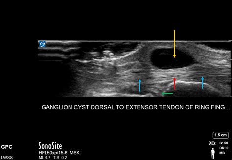 Lake Washington Sports and Spine: Ultrasound Case of the Day- Ganglion Cyst