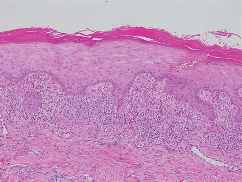 Diffuse Papular Eruption With Erosions and Ulcerations | MDedge Dermatology