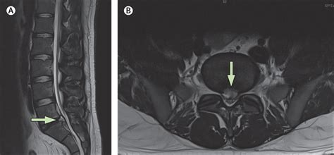 Herniated Disc Thoracic Mri