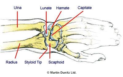 Broken Wrist - Capitate Fracture | PhysioRoom Injury Advice