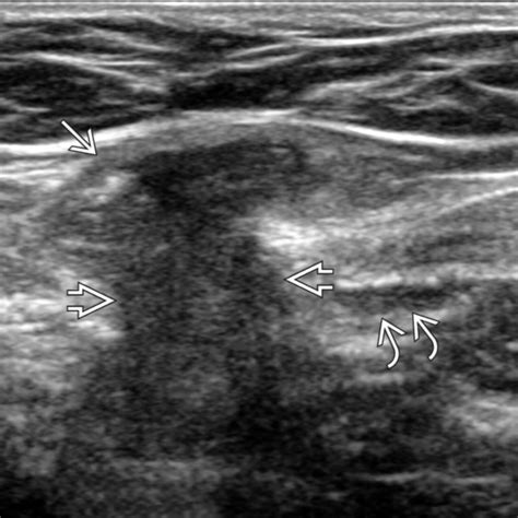 Scrotal Hernia Ultrasound