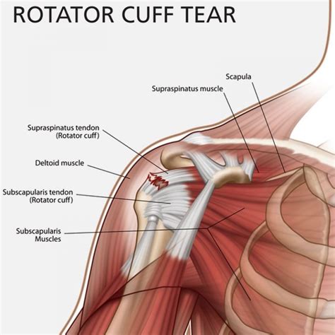 Functional Outcome After Surgical Repair of Rotator Cuff Tears in Rock ...