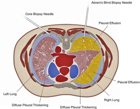 Pleural Biopsy | Radiology Key