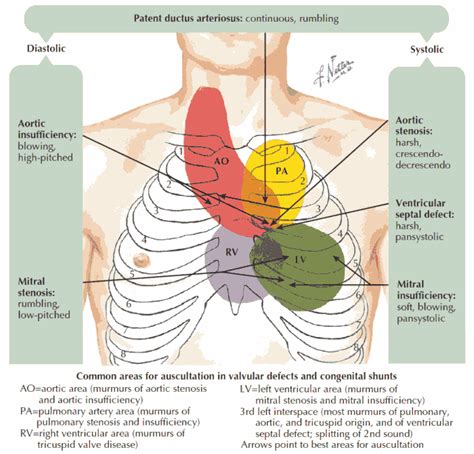 Heart Murmurs and Valvular Diseases - Differential Diagnosis ...