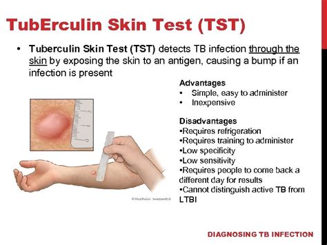 TUBERCULOSIS DIAGNOSIS TREATMENT ACTION GROUP TB HIV ADVOCACY TOOLKIT