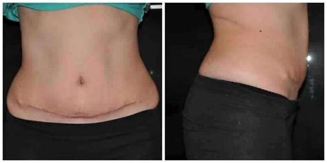 Tummy tuck scar after surgery » Tummy Tuck: Prices, Photos, Reviews ...