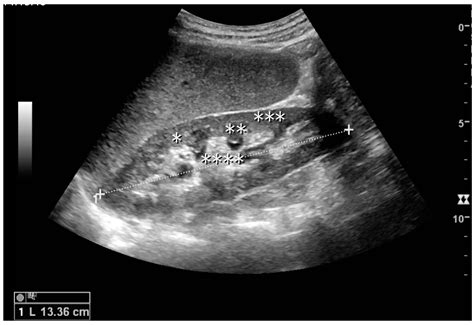 Normal Kidney Ultrasound