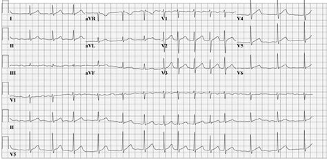 Atrial fibrillation EKG examples - wikidoc