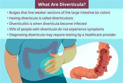 What Are Diverticula? Location, Effects, Who Has Them