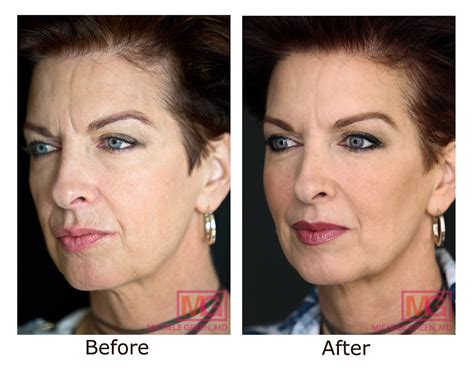 Guide to Botox Injections For Wrinkles, Jaw, Fine Lines & Neck - Botox NYC