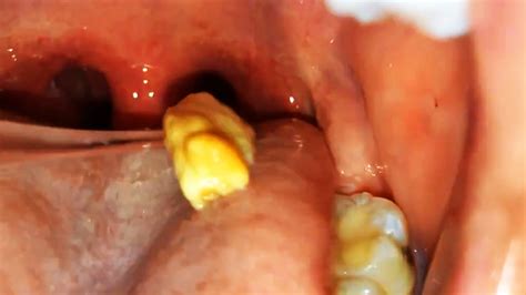 Biggest Tonsil Stones Ever ~ Tonsil Stones Removal Tips