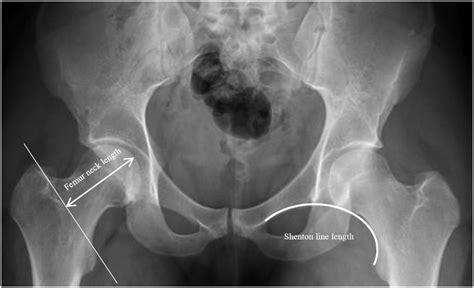 Statistical quantification of hip radiograph assessment using Shenton ...