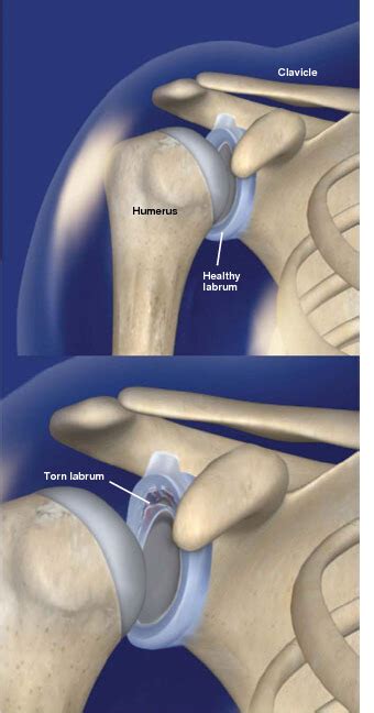 Glenoid Labrum Tears: orthopedic prescott valley az - Phoenix ...