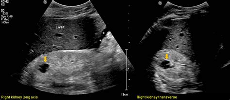 Ultrasound features of Kidney Cysts - Renal Fellow Network