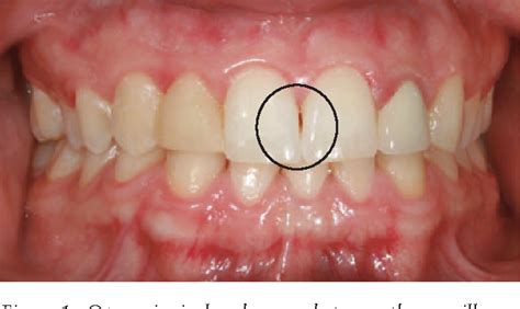 Figure 11 from Esthetic considerations in interdental papilla ...