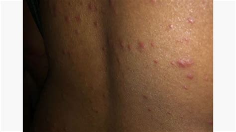 Skin Diseases Caused By Virus