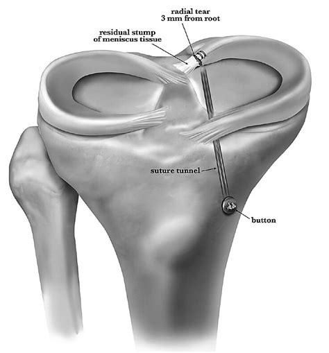 Meniscus Root Tear | Knee Doctor | Baton Rouge, LA