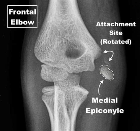 Medial Epicondyle Fractures in Young Athletes