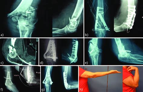 Fracture of the distal humerus with severe comminution in 48-year-old ...