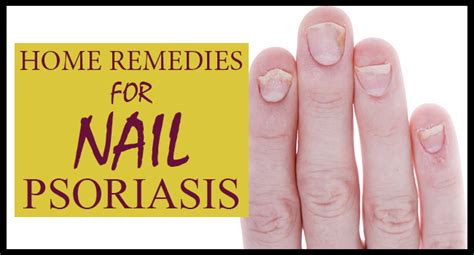 Home Remedies for Nail Psoriasis - Remedies Lore