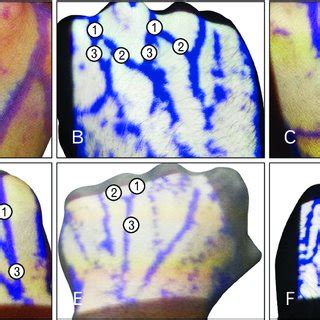 (A) Left hand showing prominent dorsal metacarpal vein (1) in the ...