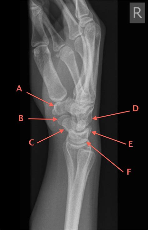 The carpal bones on a lateral plain radiograph of the wrist | The BMJ