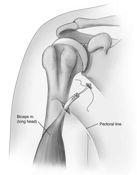 Biceps tenodesis technique, Haderer & Muller Art | Scientific ...