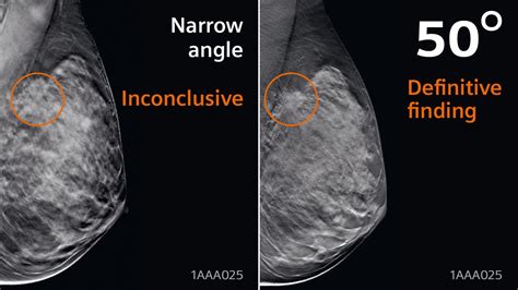 High Definition Breast Tomosynthesis – Siemens Healthineers - Siemens ...