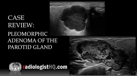 Ultrasound of Pleomorphic Adenoma of the Parotid Gland - YouTube