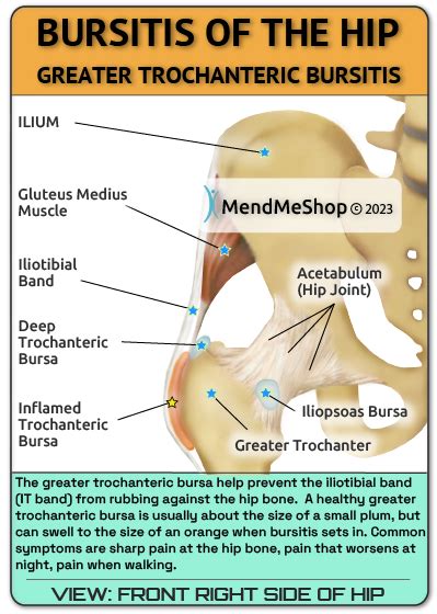 Severe Symptoms Of Hip Bursitis