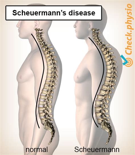 Scheuermann's disease | Physio Check