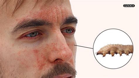 Demodex Die Off Symptoms - OZIDEX