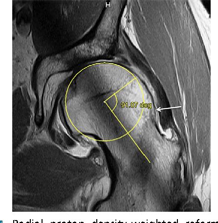 Osteoarthritis Hip Mri