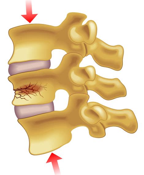 Compression Fracture Lumbar