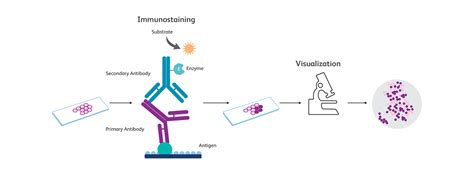 Immunohistochemistry (IHC): Valuable Diagnostic Aid For Cancers ...