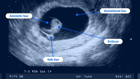 7-Week Ultrasound: Pictures, Heartbeat, Twin Pregnancy and More