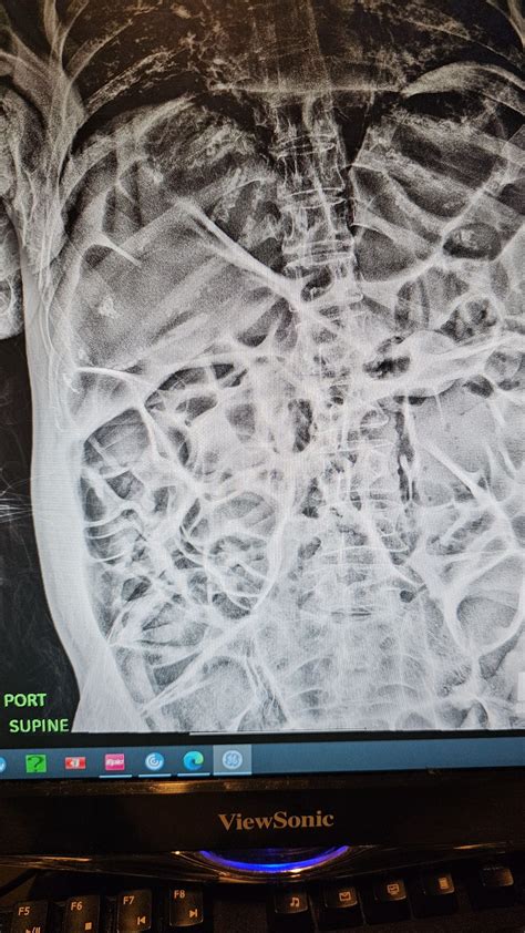 Chronic adynamic ileus : r/Radiology