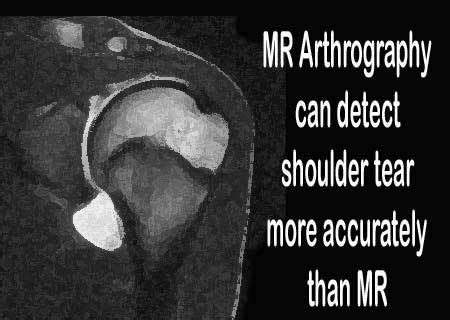 Arthrography is medical imaging to evaluate conditions of joints. It ...