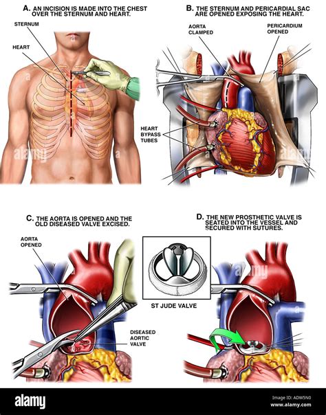 Aortic Valve Replacement Procedure Stock Photo: 7712015 - Alamy