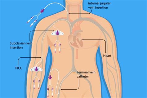 Picc Line Diagram